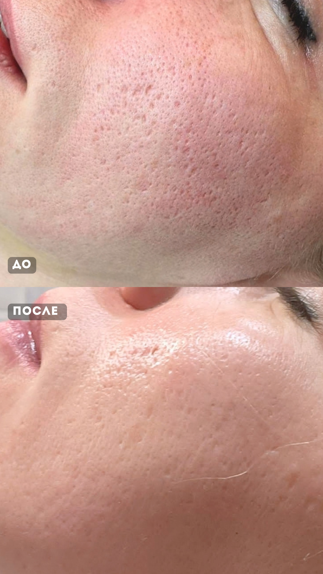 ProFracional и MicroLaserPeel результат работы с постакне