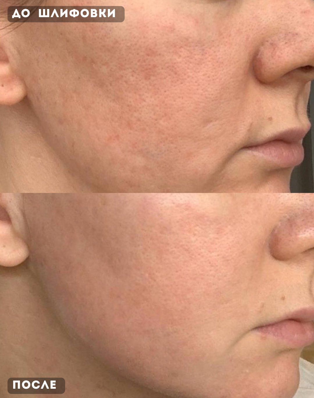 Результат после шлифовки: MicroLaserPeel + ProFractional