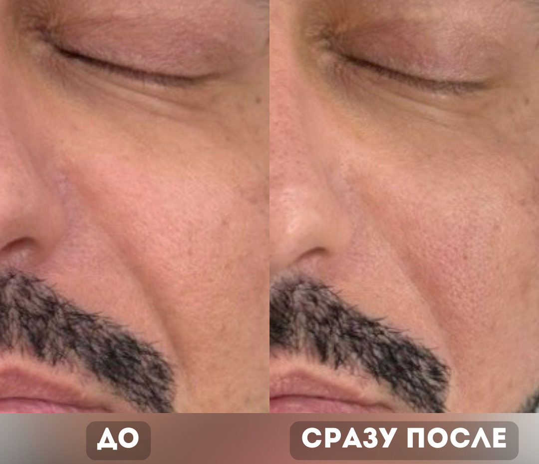 Результат аппарата Олиджио (Oligio)